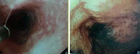 早期贲门癌内镜特征,内镜早癌