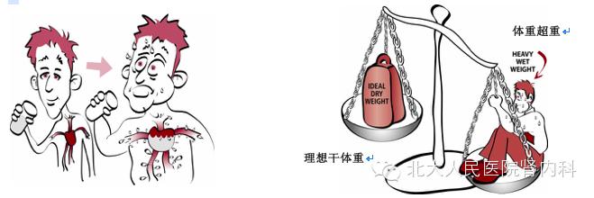 腹膜透析患者怎样控水,腹膜透析病人怎么控制喝水