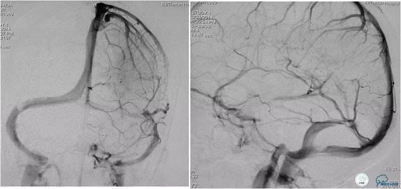 脑静脉窦狭窄放支架还能工作吗,颅内动脉支架植入术治疗血管狭窄
