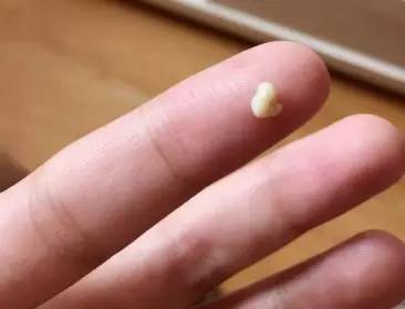 口臭腥臭味有痰什么原因,有口臭还经常咳出黄色小米粒