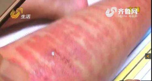 青岛女子做激光脱毛变“斑马腿”大片红肿还起泡
