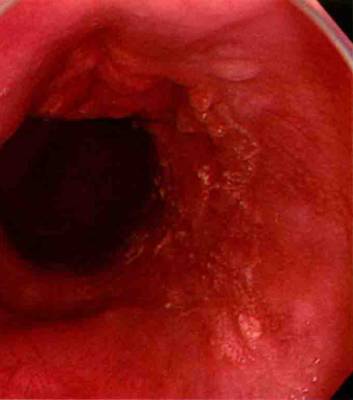 早期贲门癌内镜特征,内镜早癌