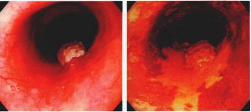 早期贲门癌内镜特征,内镜早癌