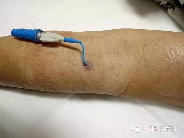 picc管旁边皮肤痒怎么办,picc膜内皮肤痒