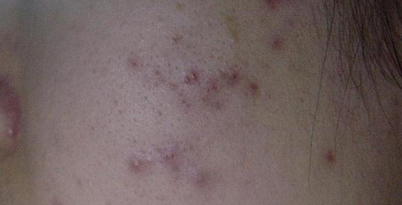 真正祛痘印最好的方法,最简单有效祛痘印的方法