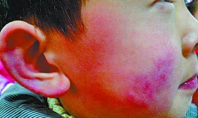 宝宝冬季冻伤,宝宝冻着了会导致低温吗