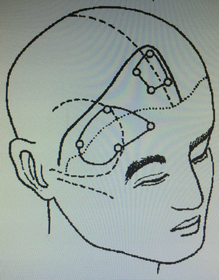 手术治疗颅咽管瘤相关问题