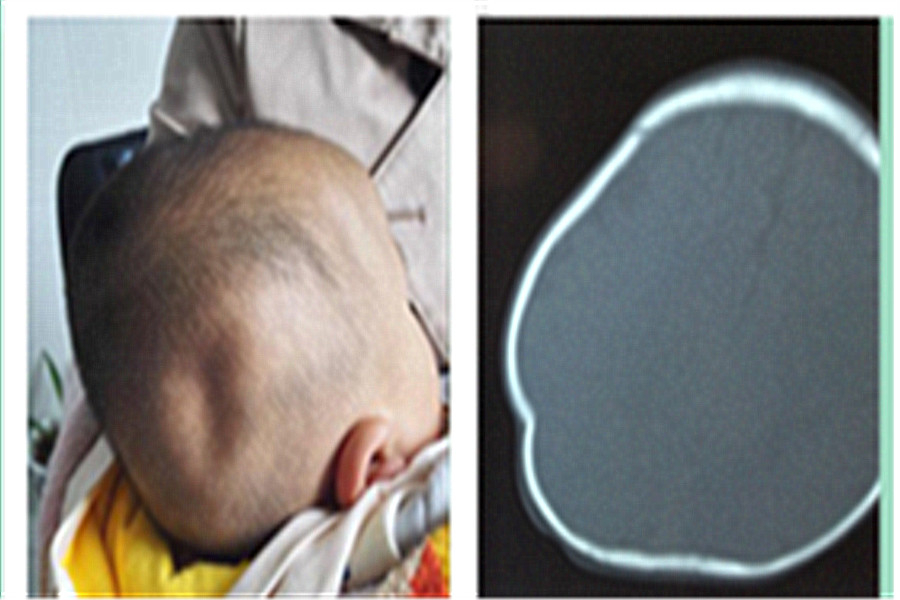 颅骨凹陷性骨折复位视频,儿童鼻骨骨折做手术是微创手术吗