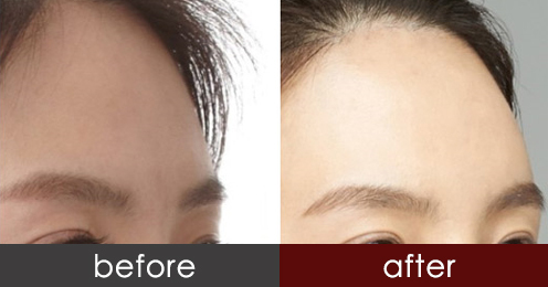 自体脂肪填充额头太高怎么消下去,额头自体脂肪填充额头太过饱满