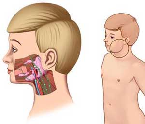 腮腺癌怎么引起的,腮腺癌是如何引起的