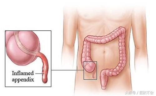 腹部疼痛的位置及疾病,肠道疾病能否导致下腹疼痛