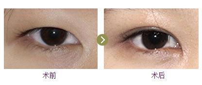 l型假睫毛能撑起双眼皮吗,嫁接假睫毛撑起双眼皮
