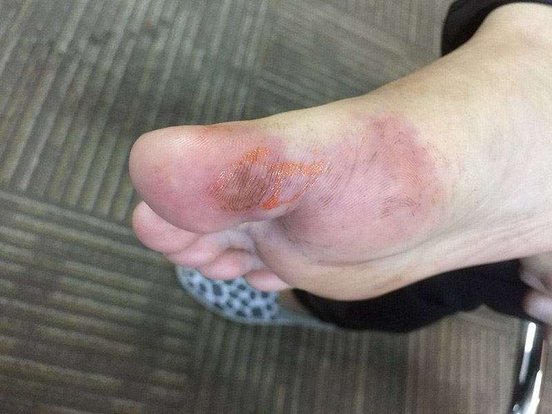 脚趾屈指肌腱的损伤,脚趾疼痛预示身体病变