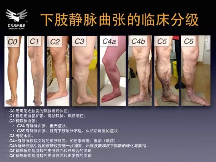 蚯蚓爬到地面上怎么回事,蚯蚓腿凸出来怎么治疗效果最好