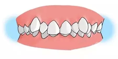 什么样的牙齿矫正需要拔牙,15岁女生牙齿矫正要拔牙吗