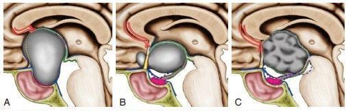 手术治疗颅咽管瘤相关问题