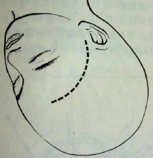 手术治疗颅咽管瘤相关问题