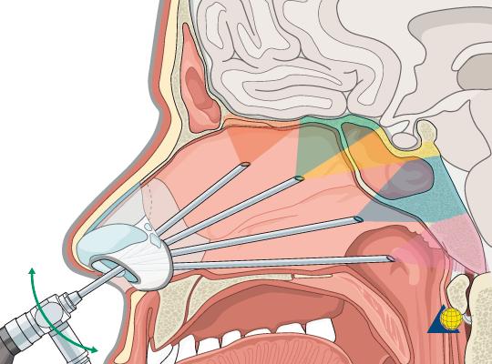 手术治疗颅咽管瘤相关问题