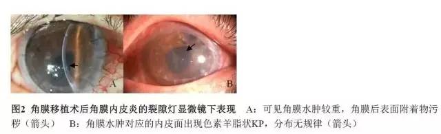 角膜内皮移植排斥反应大吗,角膜内皮移植术后的影响