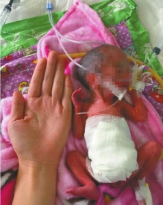 成都不到一斤的早产儿,上海早产两斤的小孩