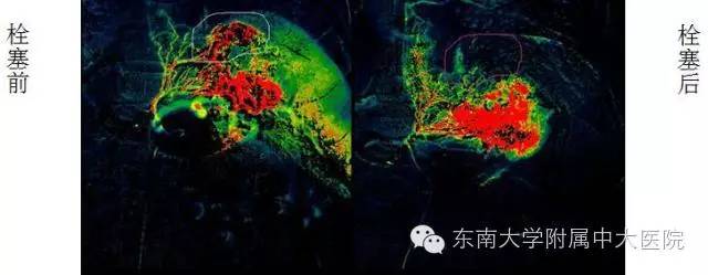 栓塞治疗有没有副作用,减肥后下肢静脉栓塞能改善吗