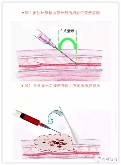 抽血后手臂淤青健身,验血后手臂一直淤青有事吗