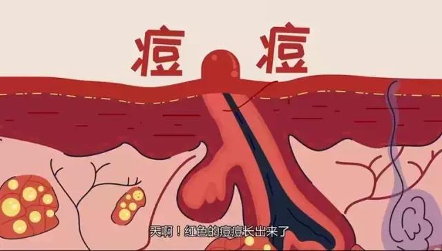 协和医院黑头清理方法,痘痘黑头粉刺医院怎么治