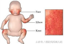 宝宝湿疹和热疹会同时出现么,宝宝同一个位置反复长红疙瘩