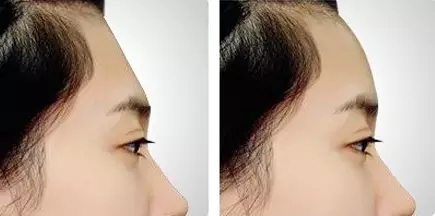 自体脂肪填充额头太高怎么消下去,额头自体脂肪填充额头太过饱满