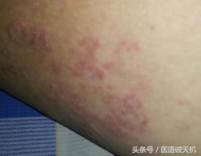 大腿根内侧起一片红疹会传染么,大腿根部有红斑很痒怎么回事