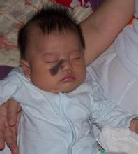 胎记、血管瘤治疗方式很重要！