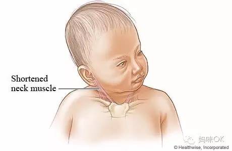 孩子这些小毛病别着急纠正,警惕宝宝四种常见隐形病