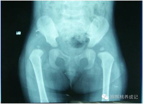 大腿纹不对称图片大全,新生儿大腿皮纹不对称怎么办