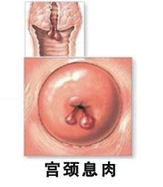 预防宫颈息肉的关注事项有哪些,宫颈息肉健康宣教指导方案