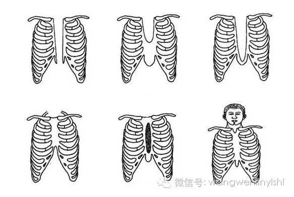 图与真相：什么是胸骨裂？