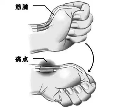 手腕腱鞘炎的艾灸疗法,手腕腱鞘炎艾灸哪个穴位