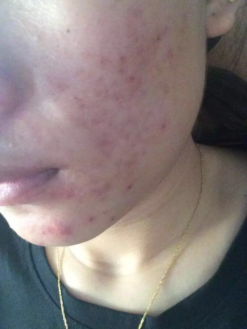 如何治疗闭口粉刺痘痘？教你一招