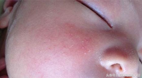 宝宝湿疹和热疹会同时出现么,宝宝同一个位置反复长红疙瘩