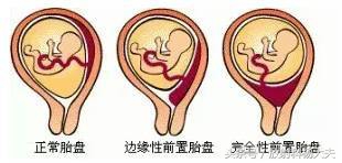 看图！胎盘跑到下面了，就是前置胎盘