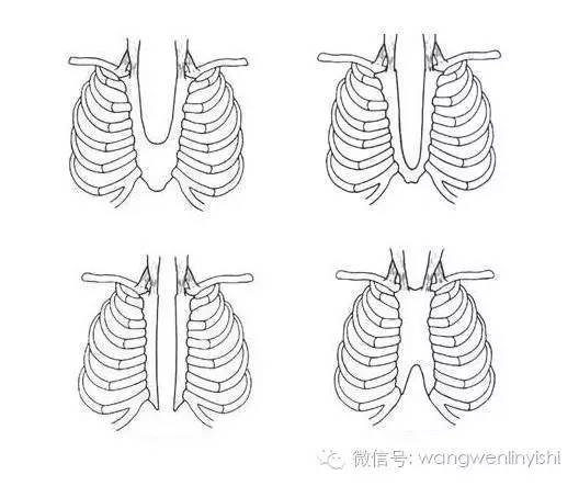图与真相：什么是胸骨裂？