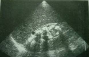 微创肾镜下肾结石碎石取石术,经皮肾镜肾结石激光碎石全过程