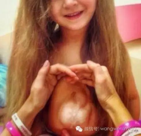 图与真相：什么是胸骨裂？