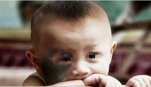 胎记、血管瘤治疗方式很重要！