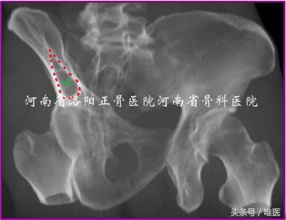 经皮置入术在骨盆髋臼骨折治疗中的应用骨医小灶第二十一期（中）