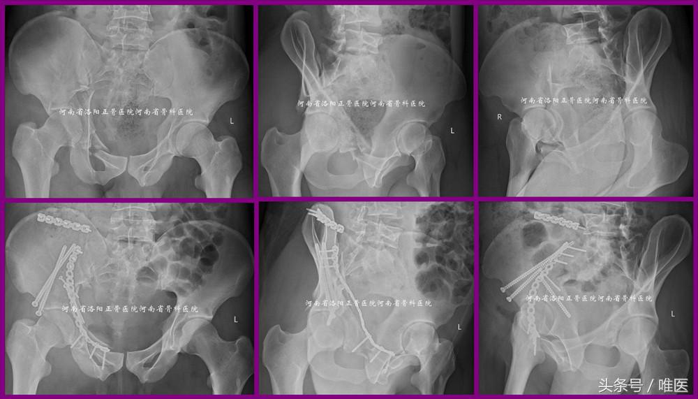 经皮置入术在骨盆髋臼骨折治疗中的应用骨医小灶第二十一期（中）