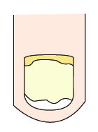 指甲出现白点、纵纹是怎么回事？