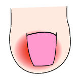 指甲出现白点、纵纹是怎么回事？