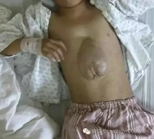 图与真相：什么是胸骨裂？