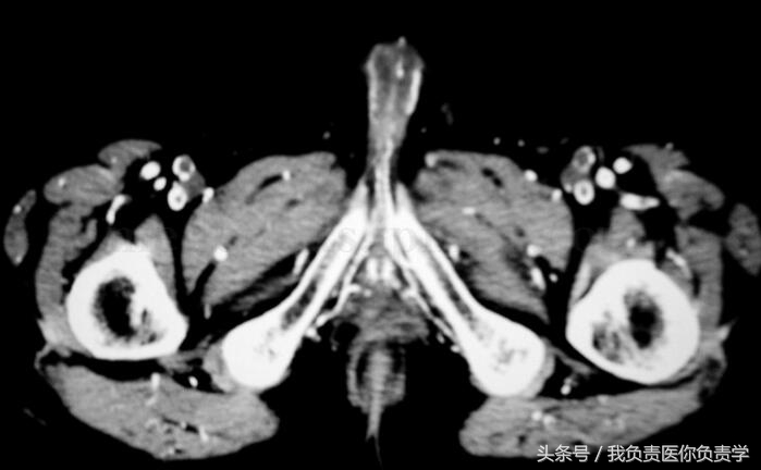 肾移植后坏死能活多久,肾移植后常见的感染部位有哪些