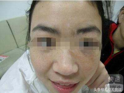 治面部白癜风最有效的方法,脸部有白癜风应该用什么护肤